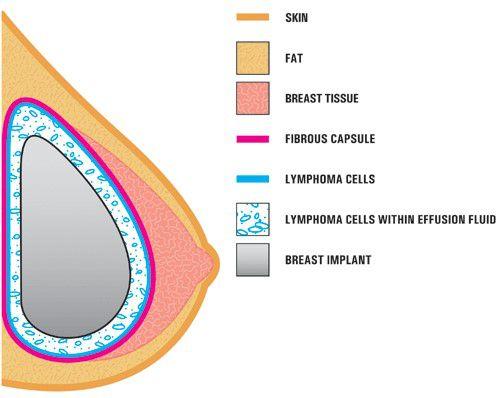 Blog breast implants recalled after cases of cancer death 2