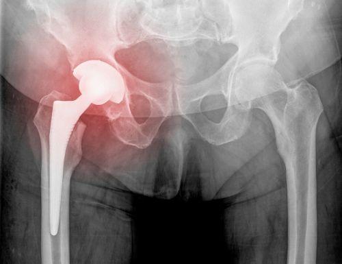 Healthcare professionals warned that asr, a hip replacement device, has high early rate of failure