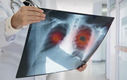 Is small cell lung cancer caused by asbestos?