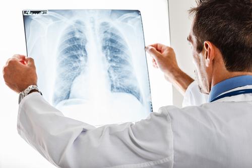 How quickly does lung cancer progress?