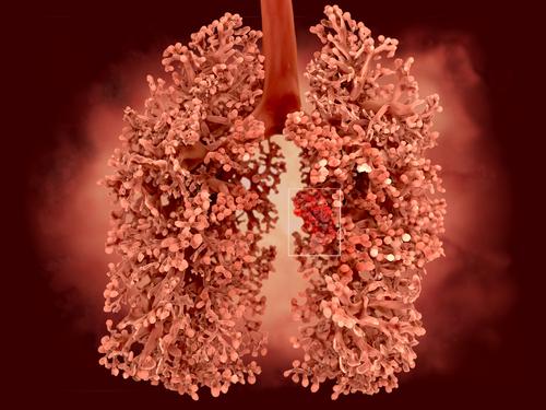 What are the symptoms of asbestos lung cancer?