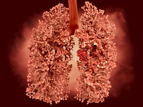 What are the symptoms of asbestos lung cancer