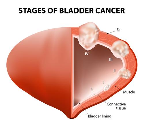 Can Bladder Cancer Be Caused by Asbestos