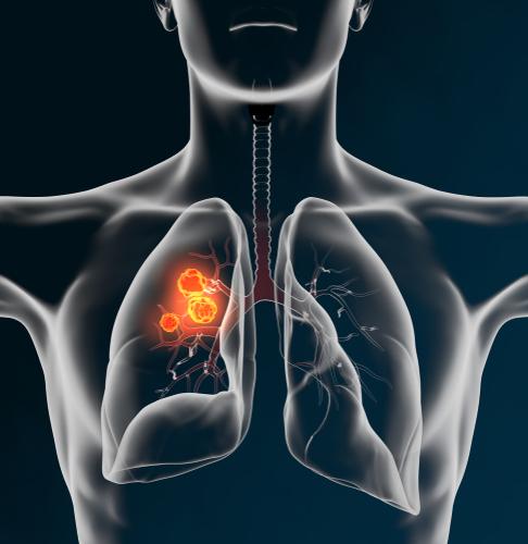 What is the most aggressive form of lung cancer?