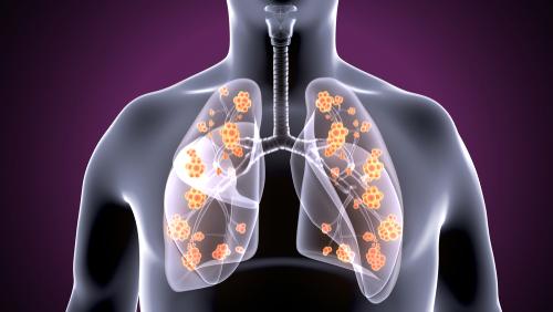 What tests are done for lung cancer?