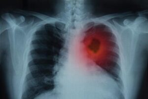 Can a ct scan detect cancer in a lung?