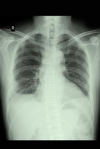 diagnostic criteria for emphysema