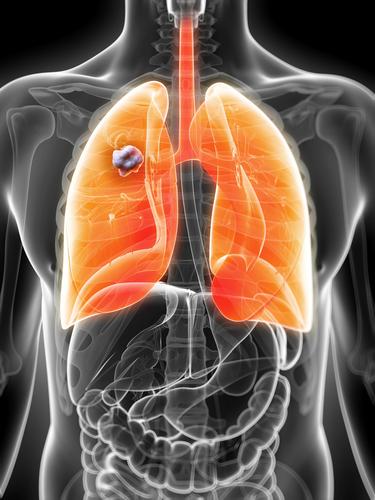 What’s the difference between lung cancer and mesothelioma?