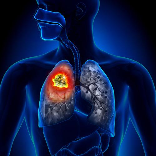 Can chemo and radiation cure stage 3 lung cancer?