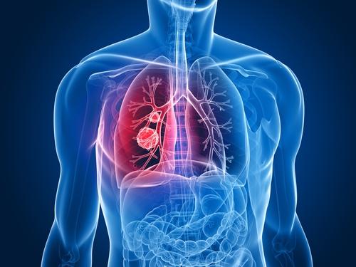 Can lung cancer be caused by asbestos?