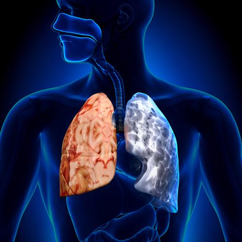 Can You Survive Lung Cancer if Caught Early