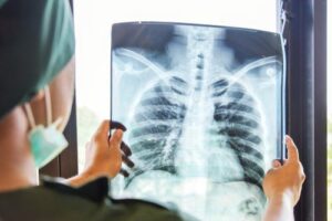 How Do You Get Mesothelioma Lung Cancer?