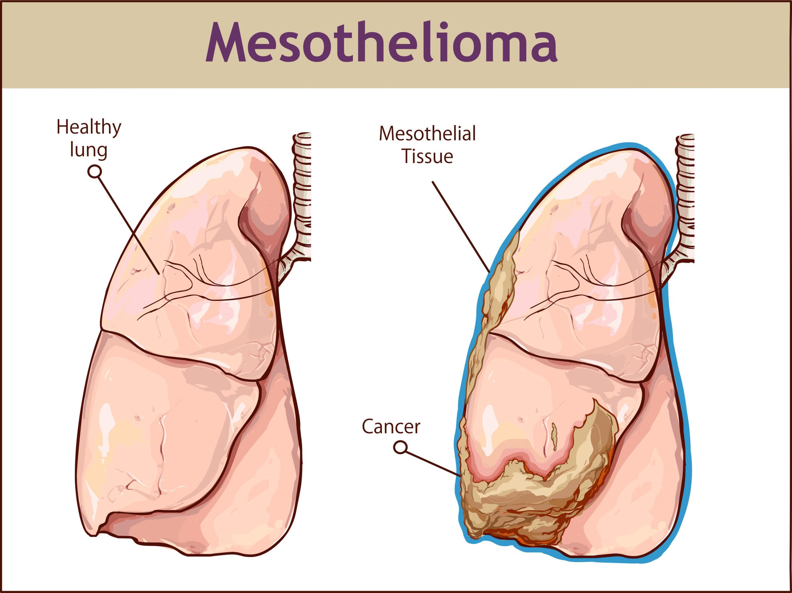 Is mesothelioma considered lung cancer?