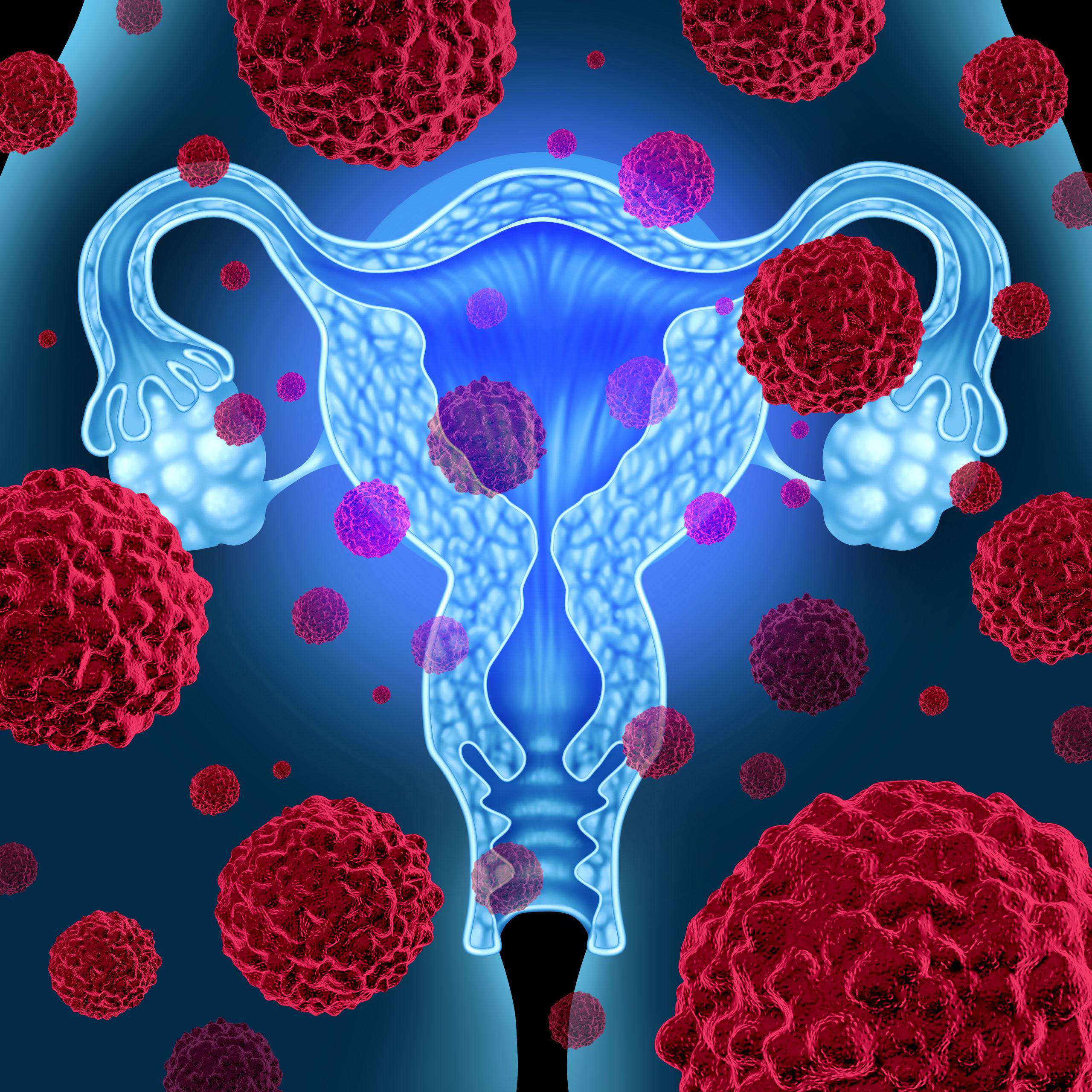 What are the symptoms of stage 1 ovarian cancer