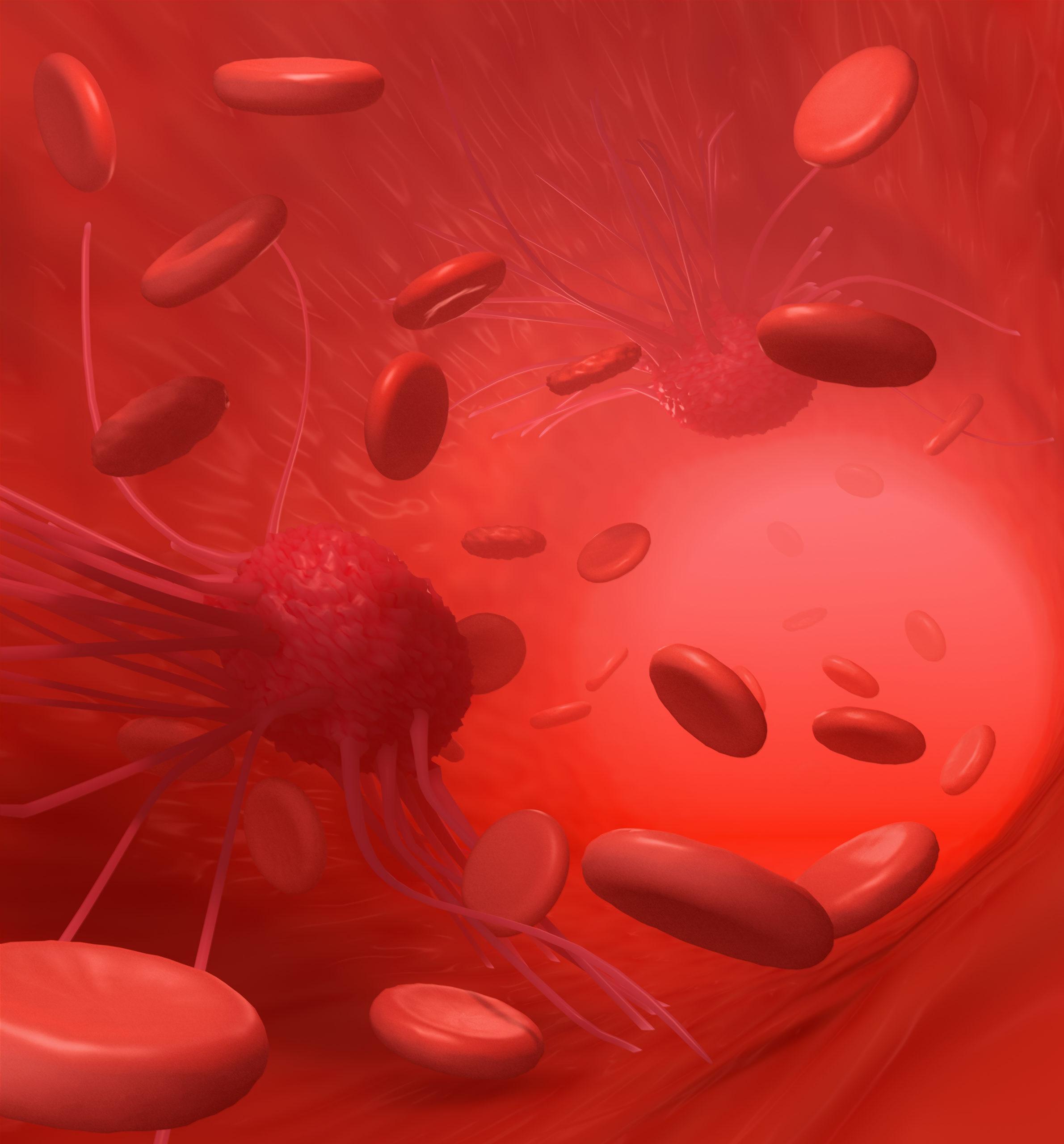 Where Does Ovarian Cancer Spread First