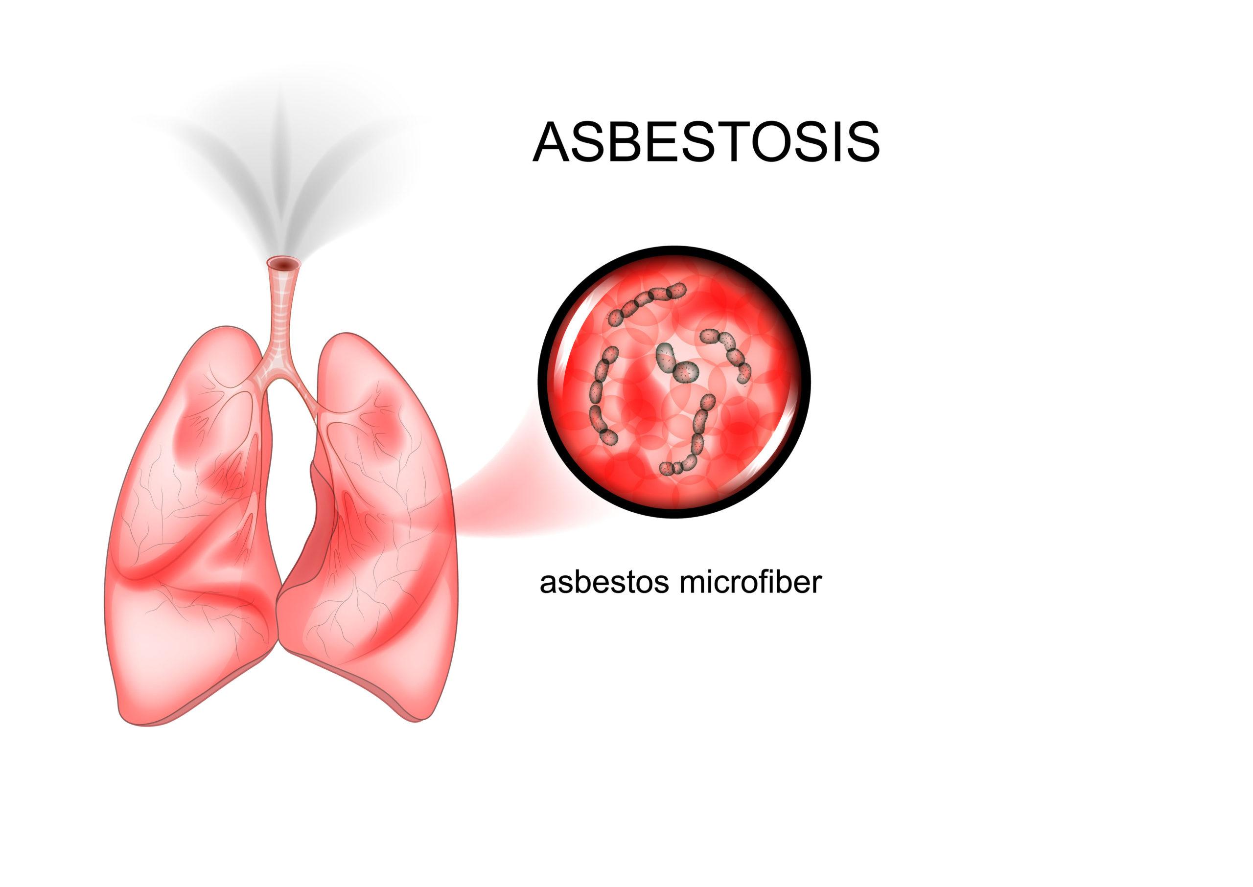 Can asbestos cause lung nodules?