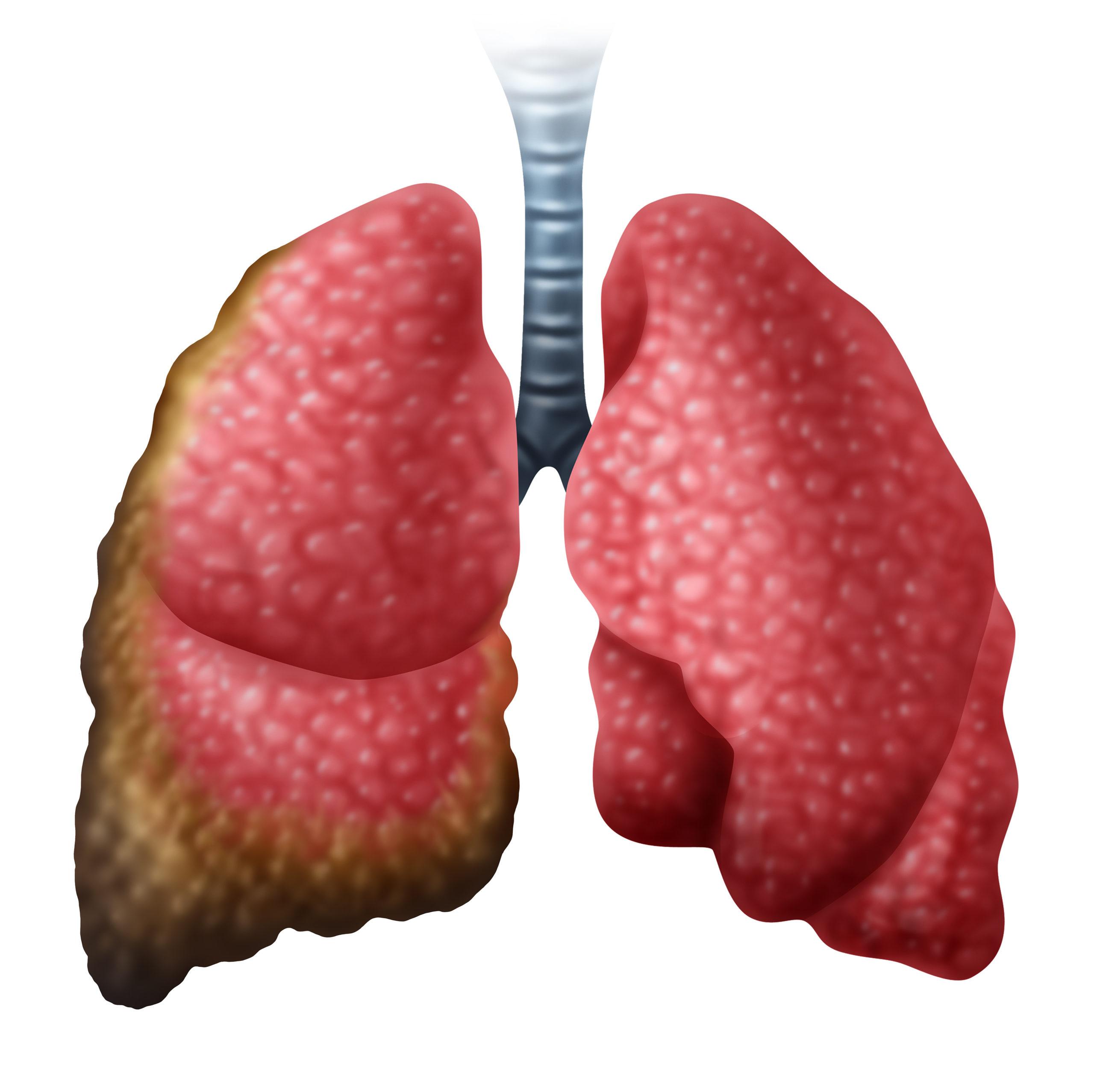 Can mesothelioma be benign?