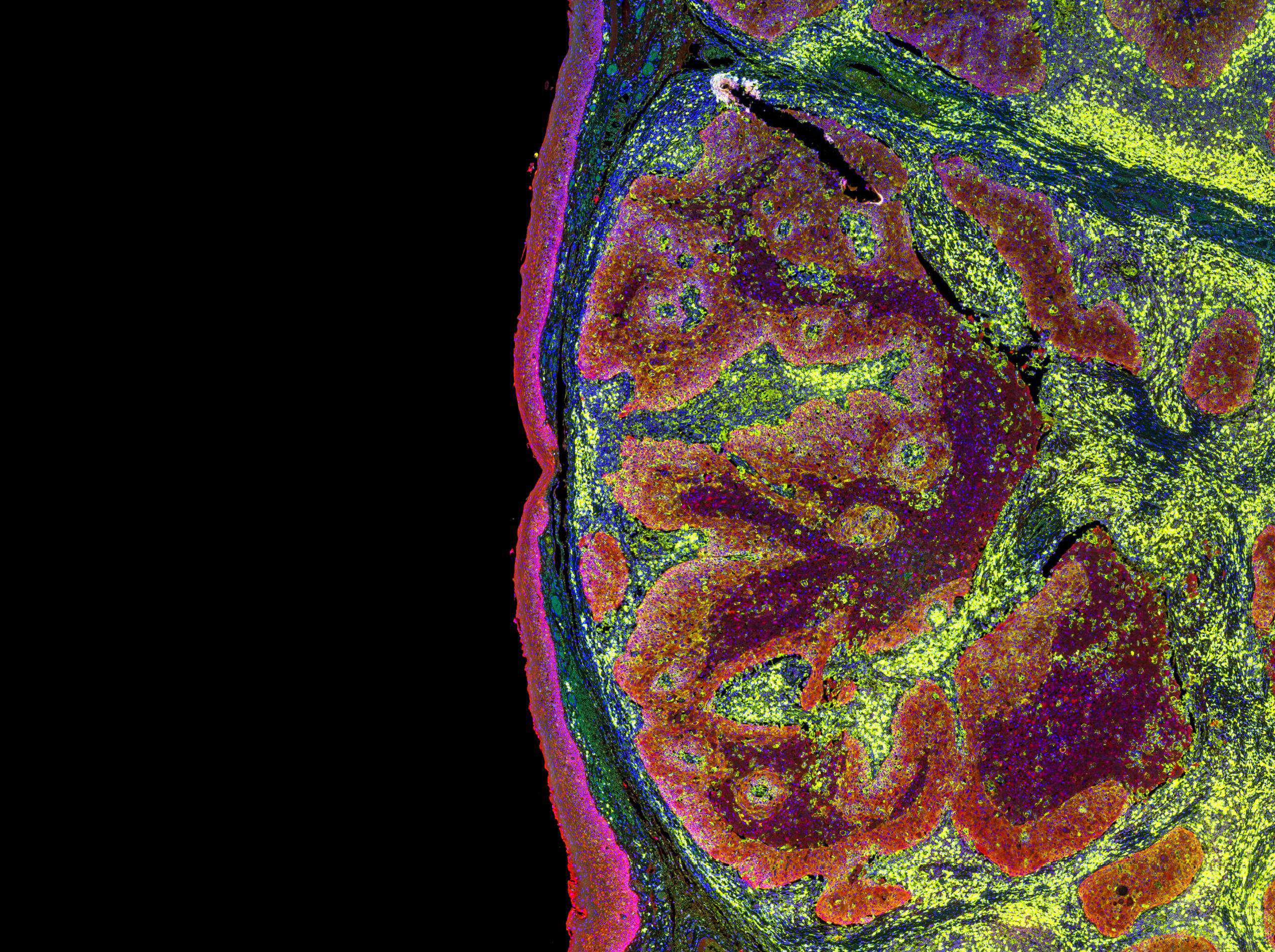 cystic mesothelioma pleural