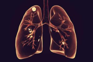 What percentage of lung nodules turn out to be cancer?