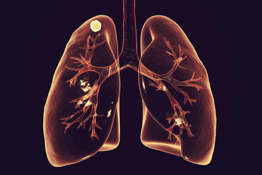 What percentage of lung nodules turn out to be cancer?
