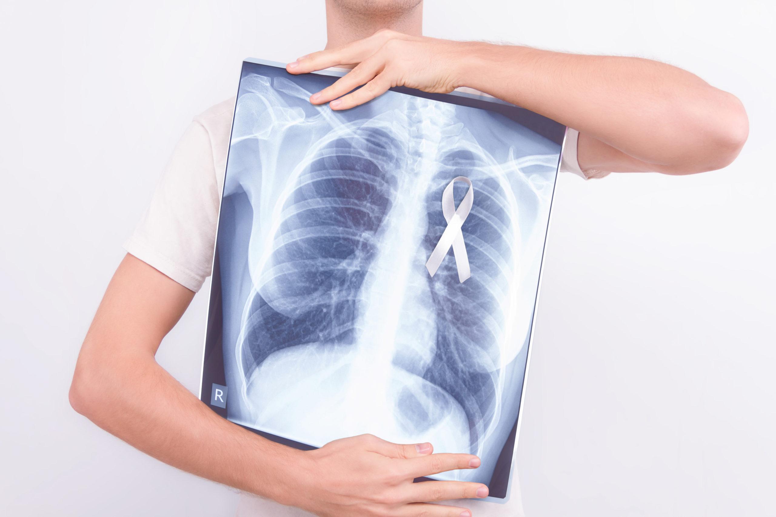 Can you have lung cancer with no symptoms?