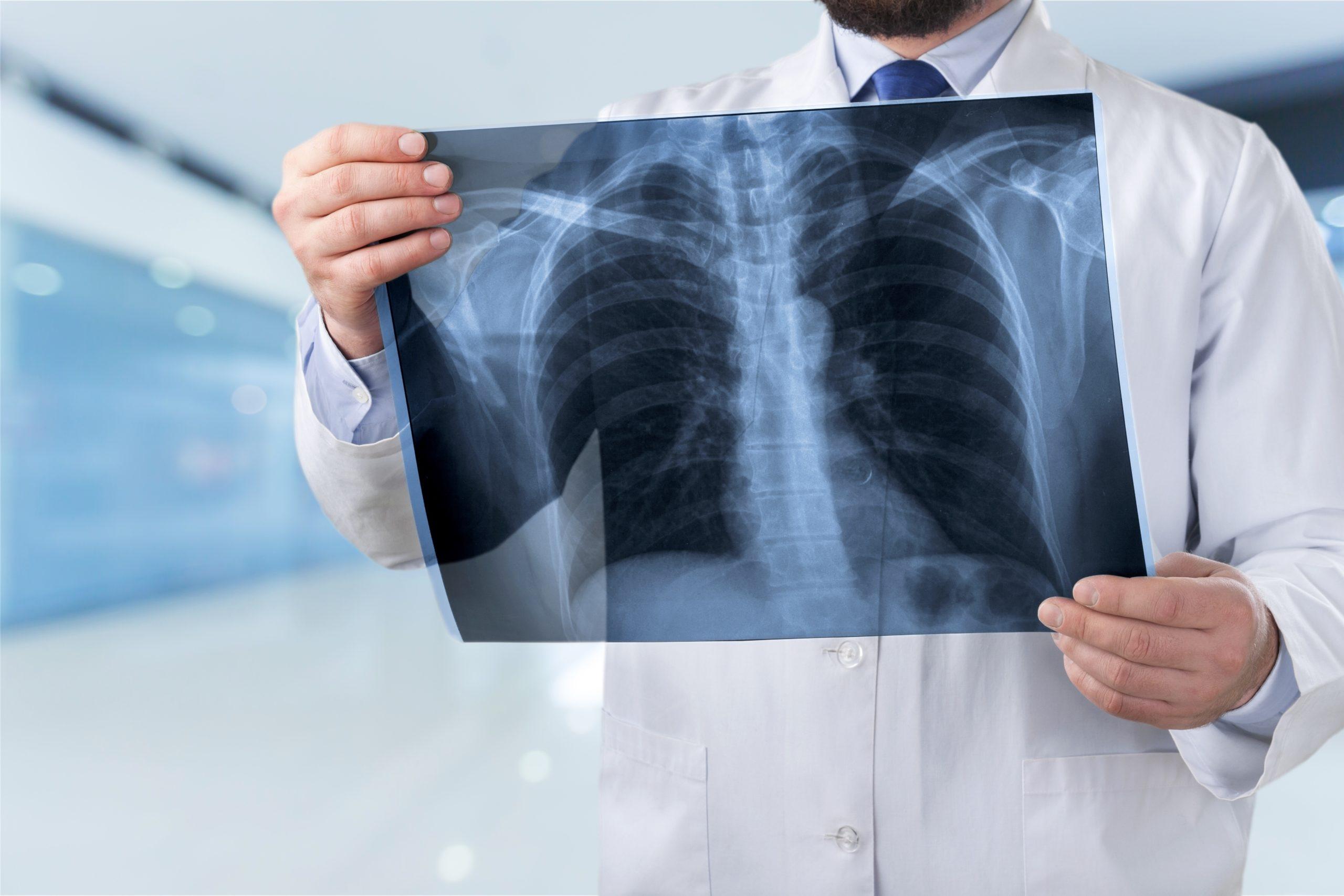 How do doctors check for mesothelioma lung cancer?