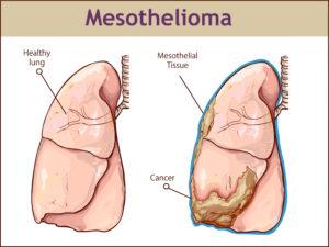 What causes mesothelioma lung cancer?