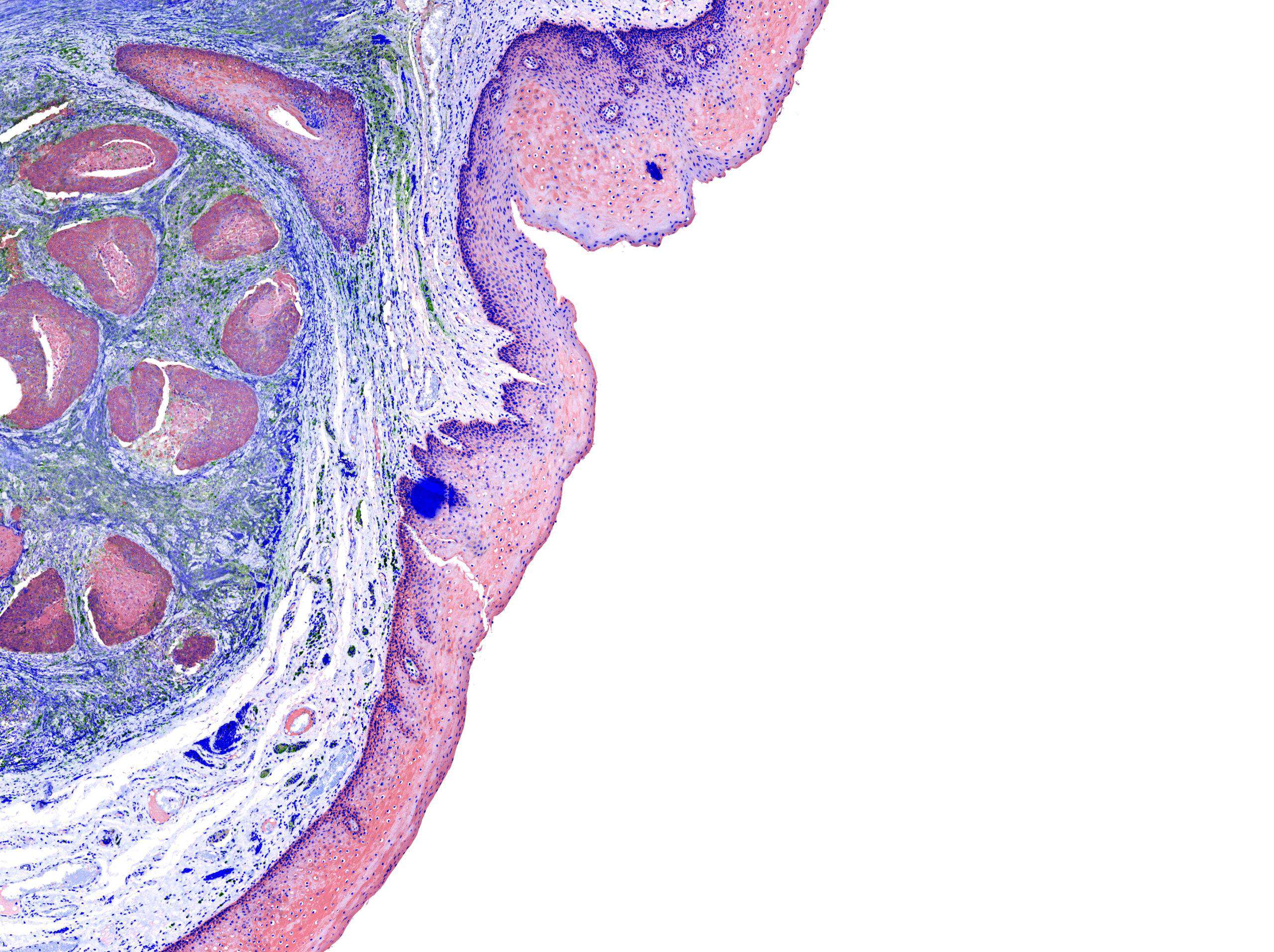 What is the life expectancy of a person with mesothelioma