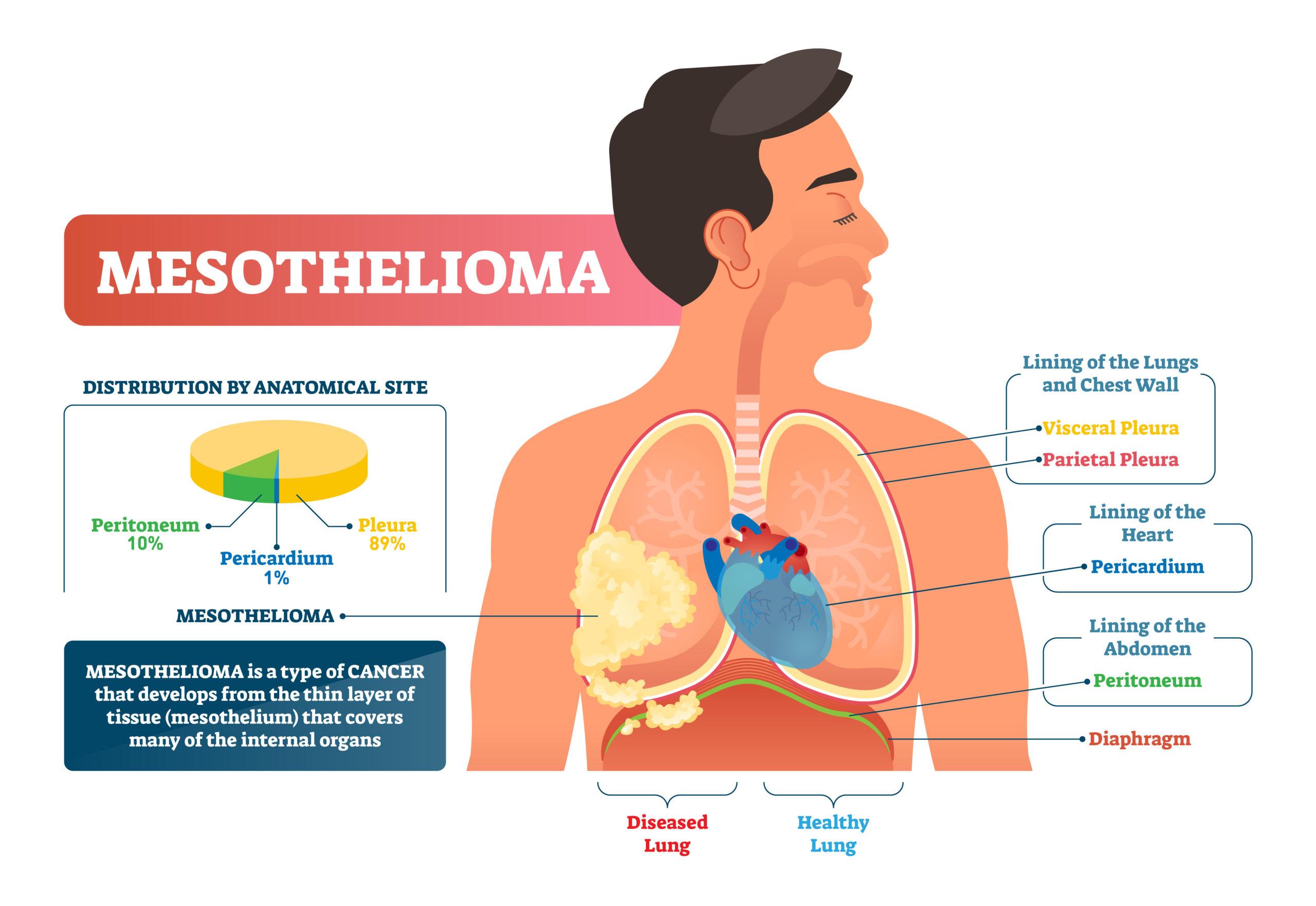 mesothelioma cases law