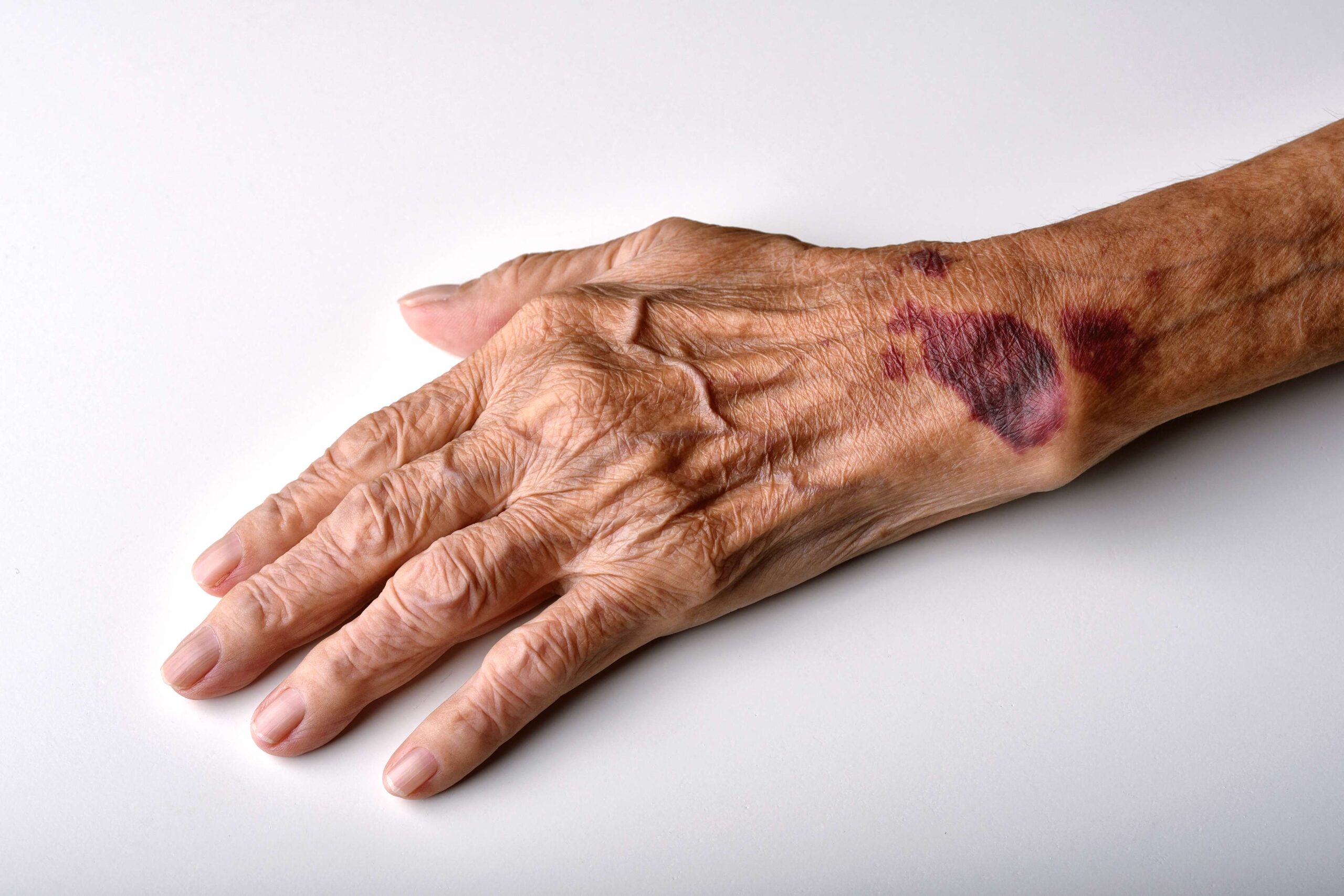 bruises