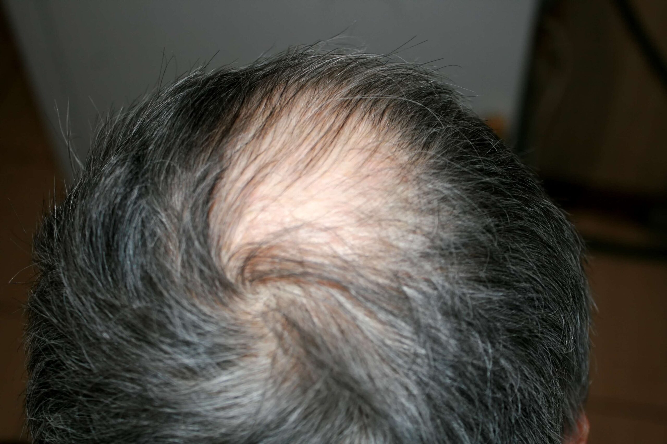 Rapid Weight Loss or Hair Loss