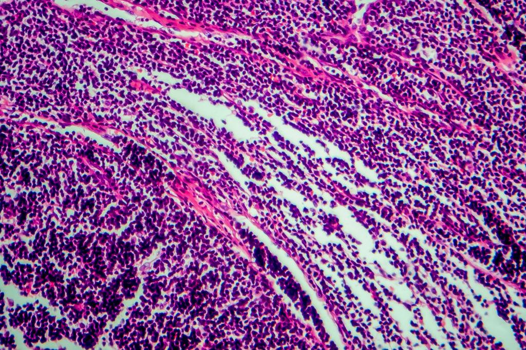 Does Roundup Cause Non Hodgkin's Lymphoma? Pintas & Mullins Law Firm