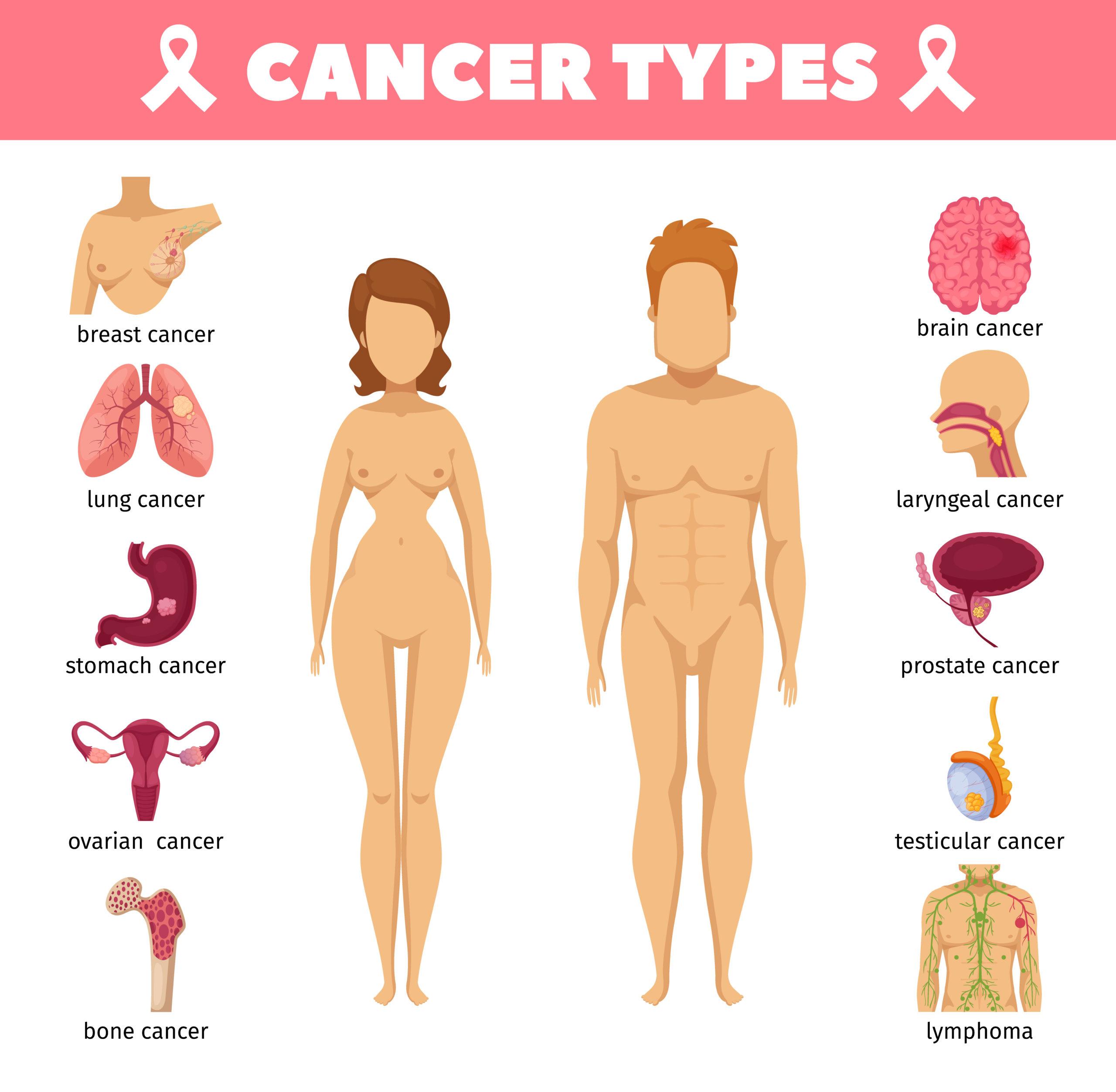what kind of cancer does roundup cause