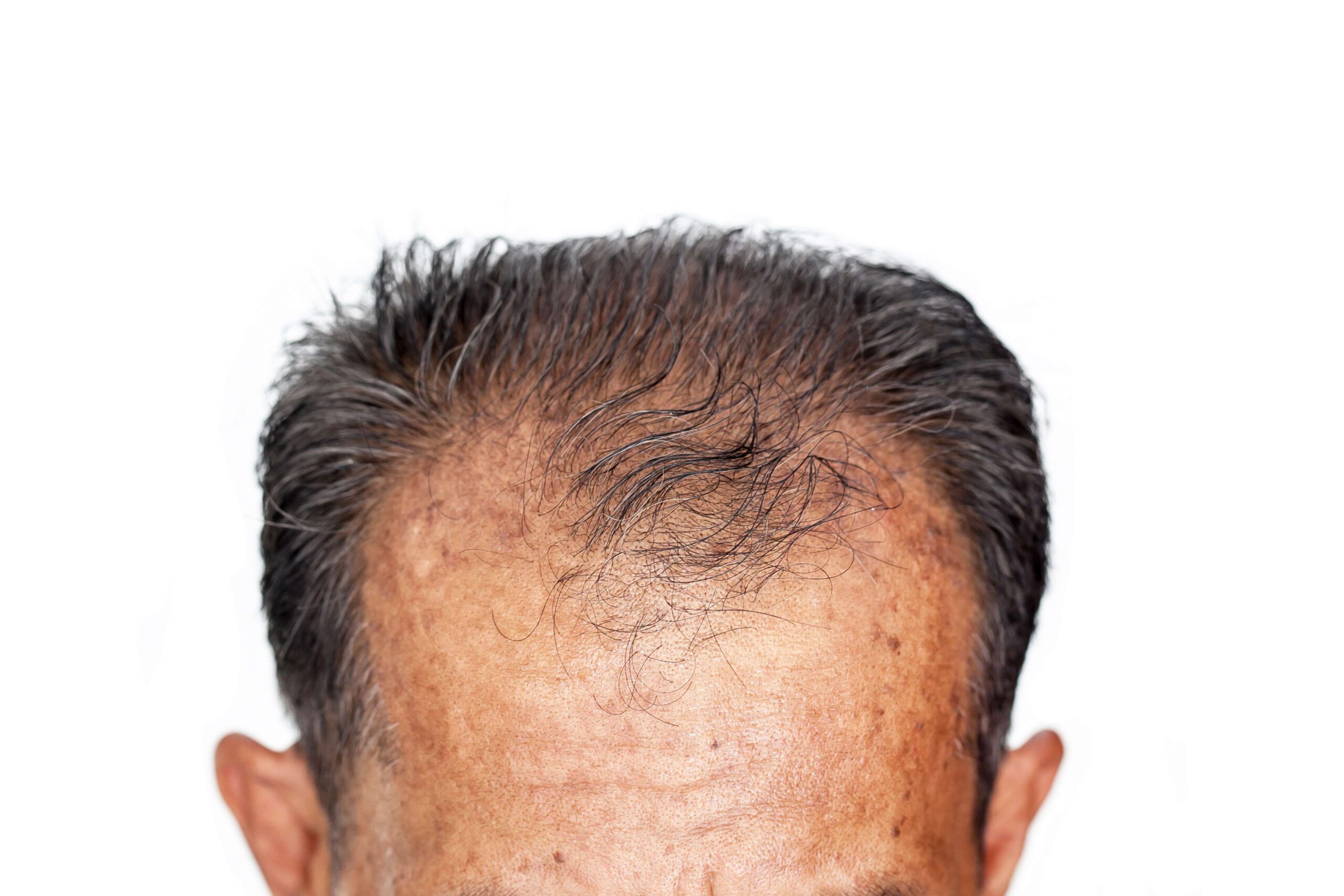 Chicago Rapid Weight Loss or Hair Loss Lawyer