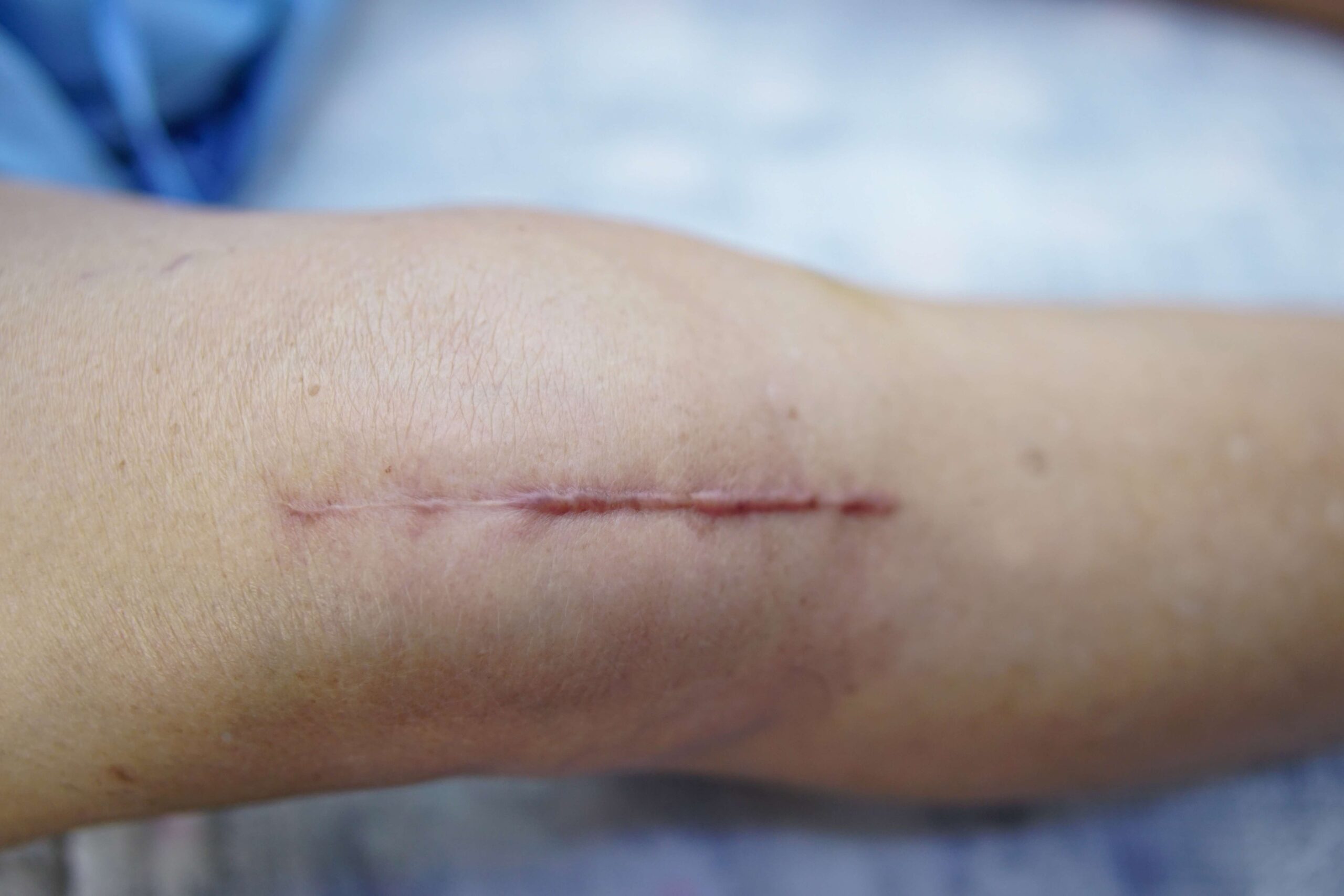 Chicago Unexplained Bruises or Cuts or Burns Lawyer