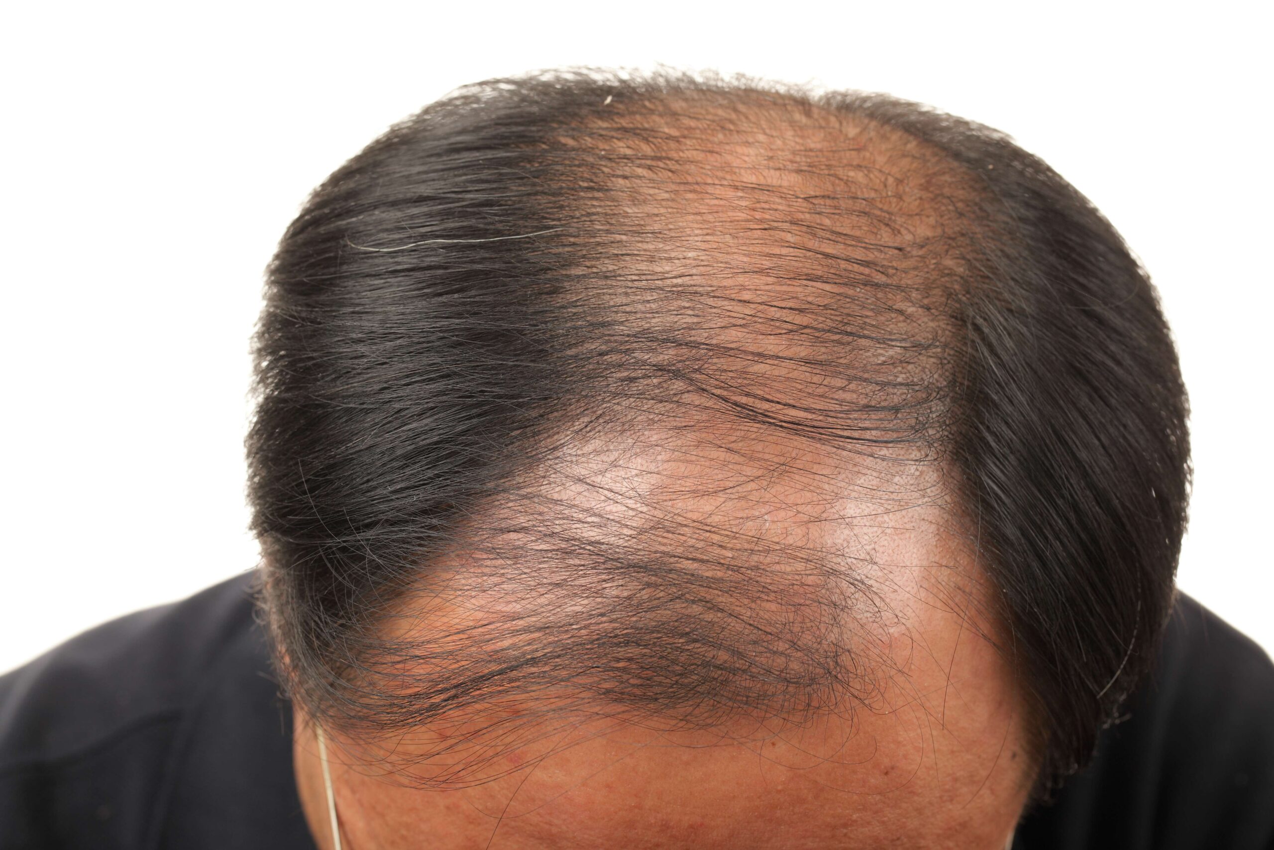 Forest Park Rapid Weight Loss or Hair Loss Lawyer