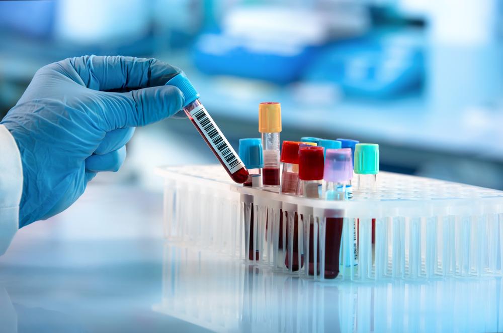 Is There a Blood Test for Asbestos Exposure