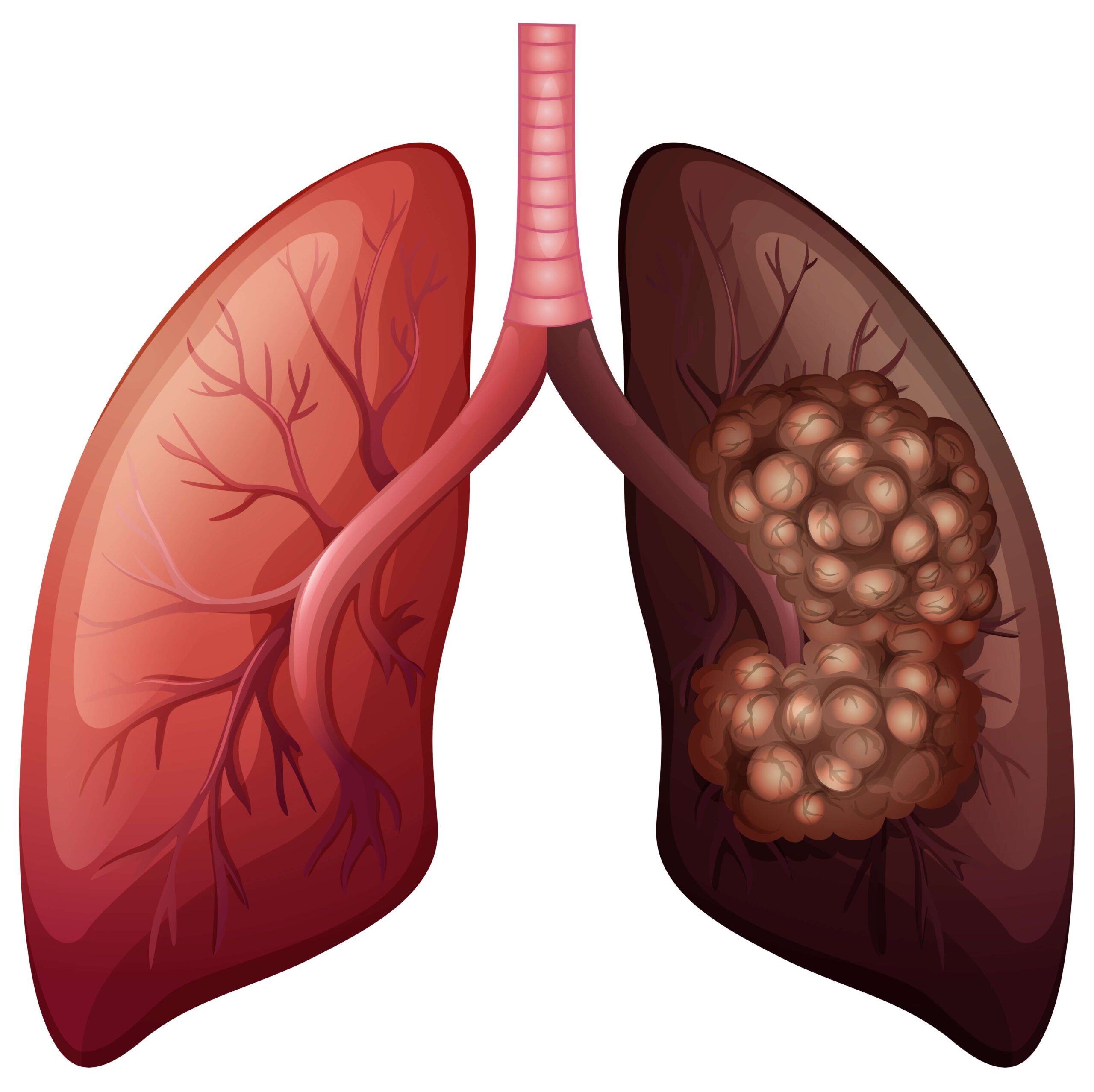 What is early stage lung cancer