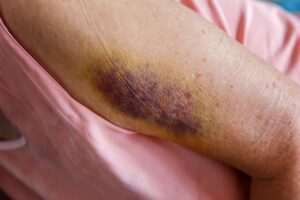 How can elderly people prevent bruising