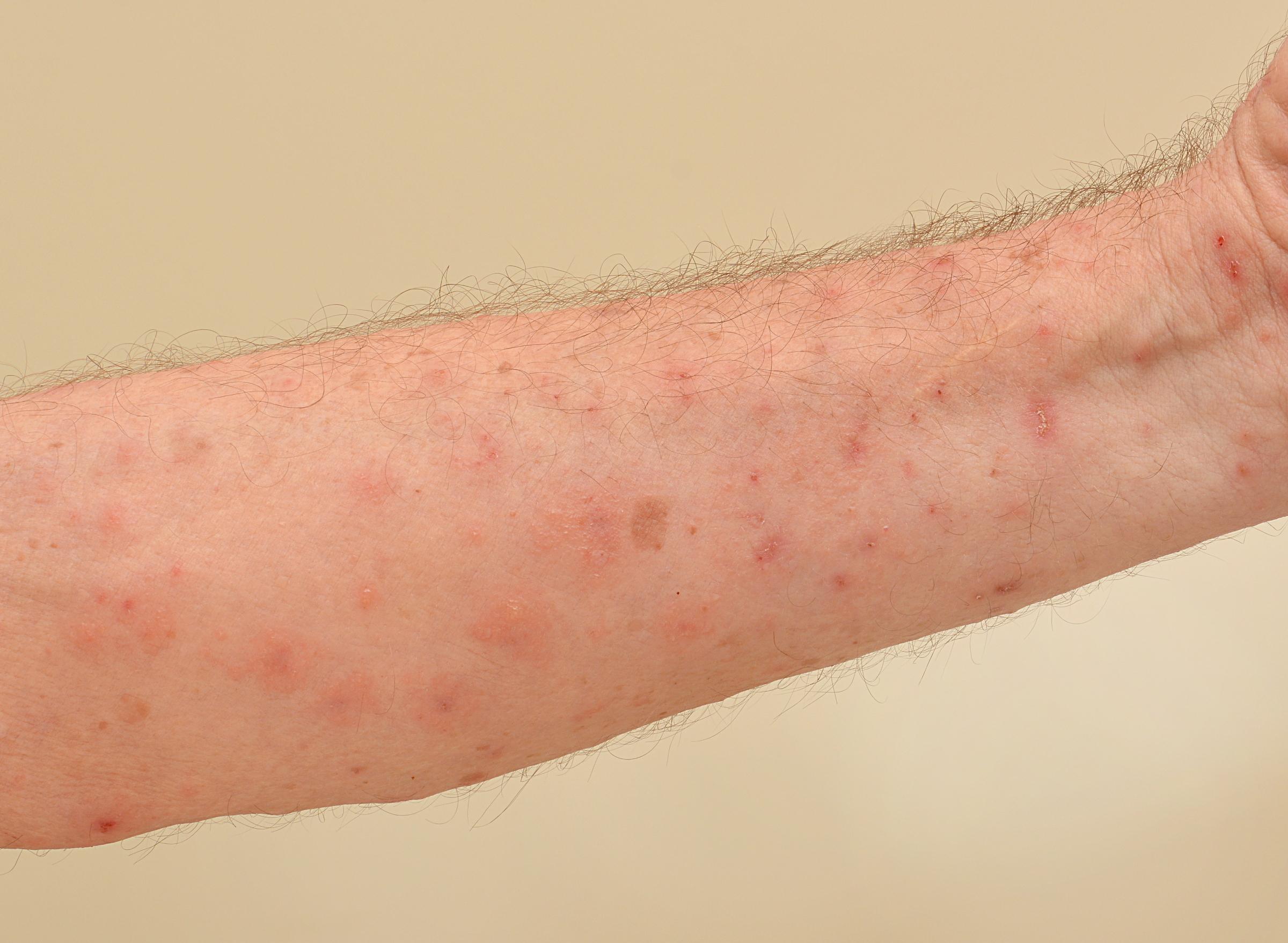What causes scabies in nursing homes