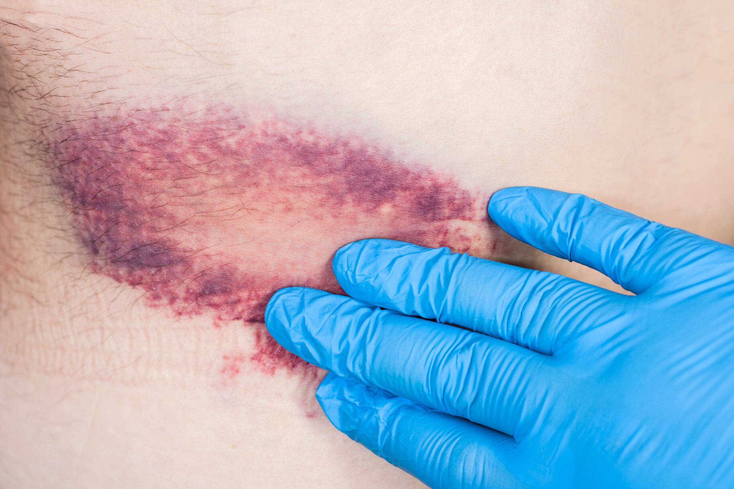 What causes bruises on older adults?