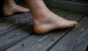What Is Subdural Hematoma?