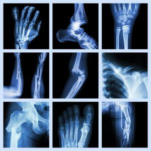 Most common bone fractures