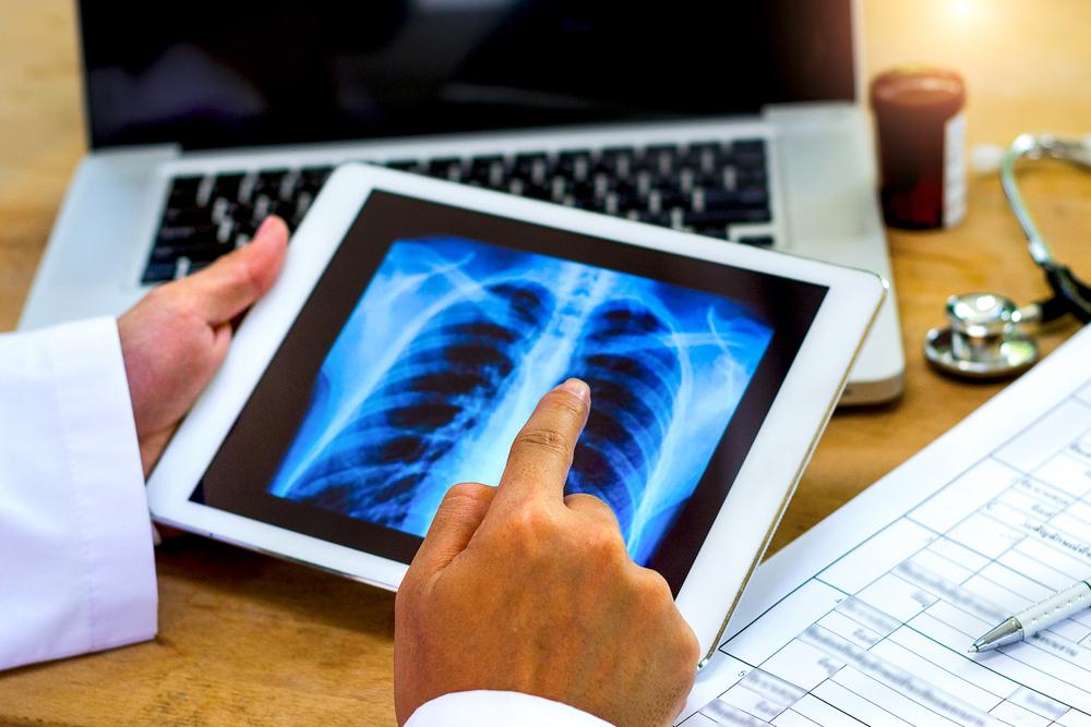 Alternative Lung Cancer Treatments