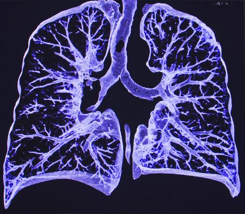 Can you be misdiagnosed with lung cancer?