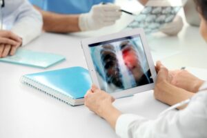 Is Lung Cancer Genetic or Hereditary?