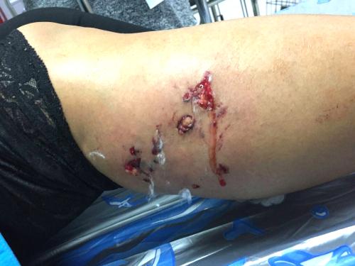 How Do I Know if a Dog Bite Is Infected