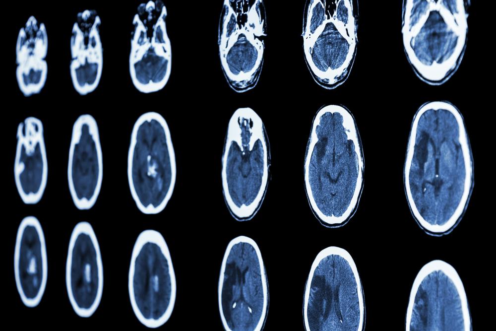 Ct scans of brain hemorrhage