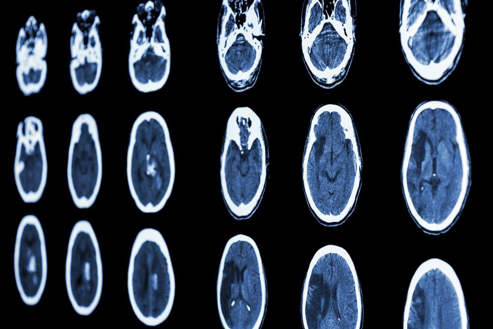 Ct scans of brain hemorrhage