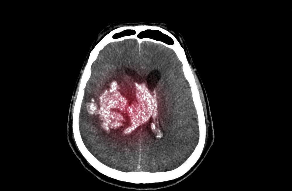 Ct scan of a brain hemorrhage